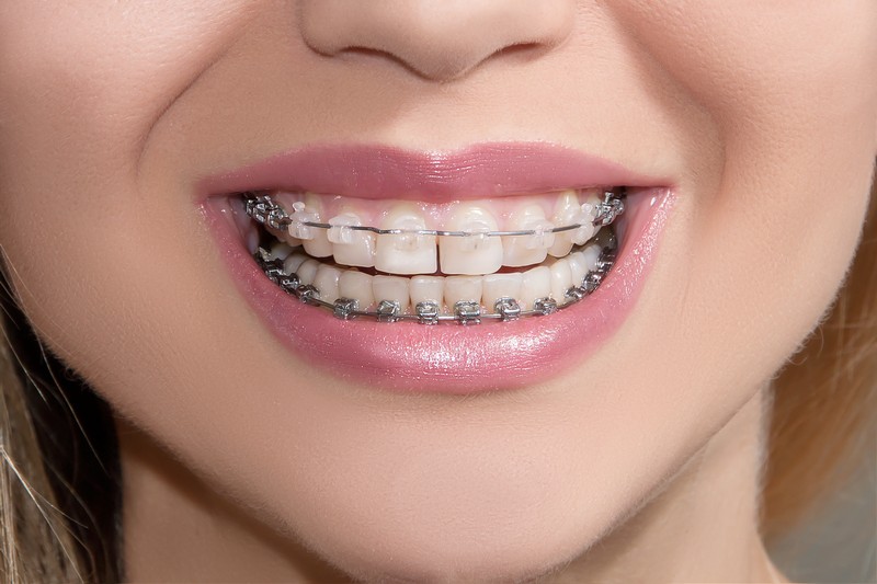 Orthodontic Services in Hayward
