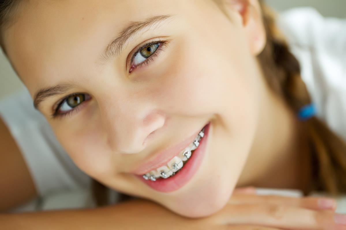 Traditional Braces